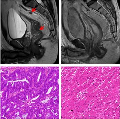 Pathological complete response in MMR-deficient/MSI-high and KRAS-mutant patient with locally advanced rectal cancer after neoadjuvant chemoradiation with immunotherapy: A case report